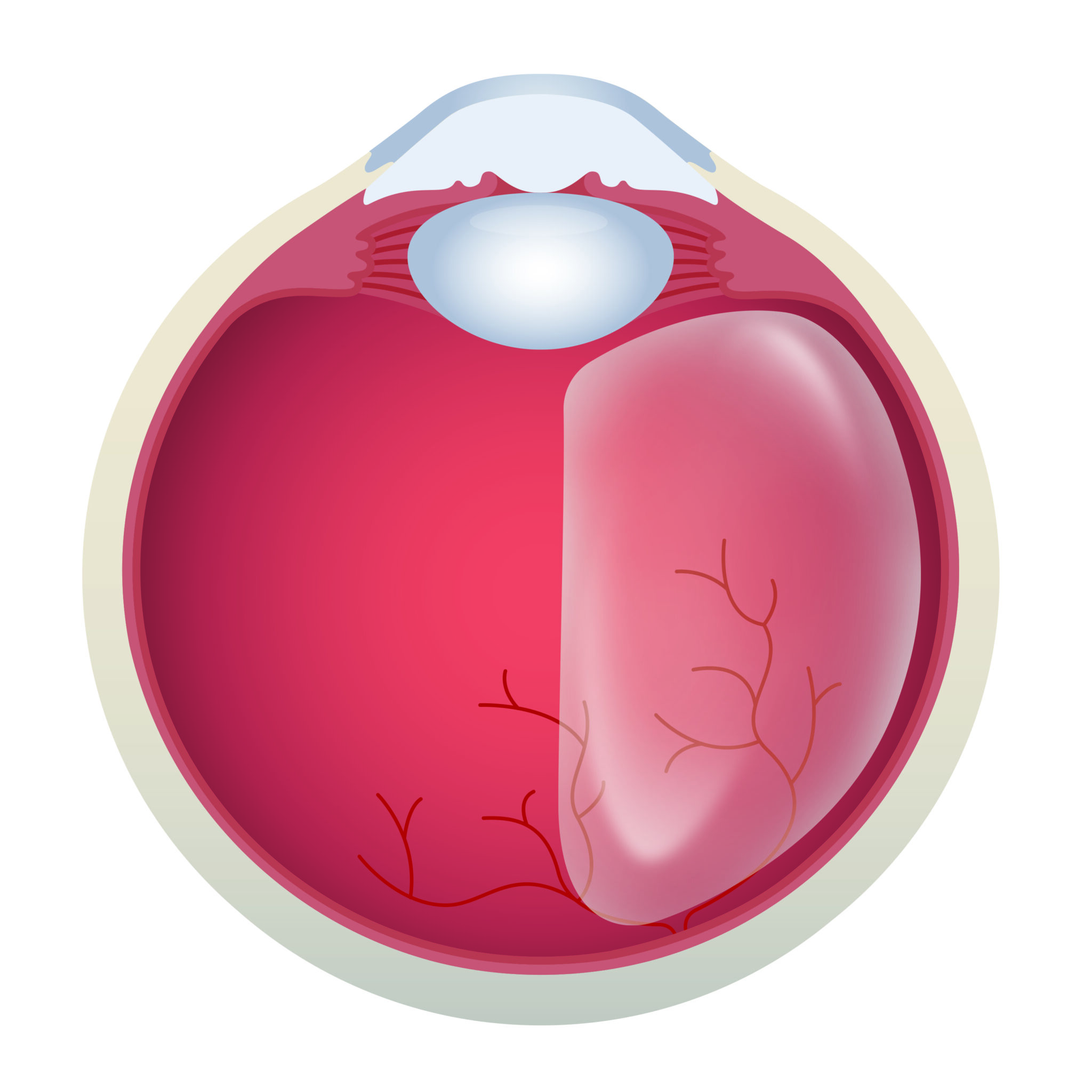 Netzhaut-Operation - Nordblick